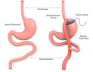 gastric band with plication