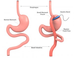 gastric band with plication